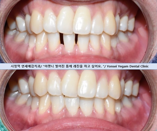 벌어진 앞니 치료, 하루에 가능, 실제케이스 및 가격 비용 관련 이미지 5
