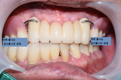 [남대문시장] 임플란트 조금 더 안아프고 간편하게 관련 이미지 4