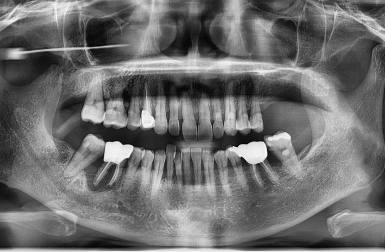 [시청역/을지로] 임플란트 진단 상담 비용? 관련 이미지 1