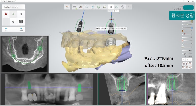 [시청역/을지로] 임플란트 진단 상담 비용? 관련 이미지 16
