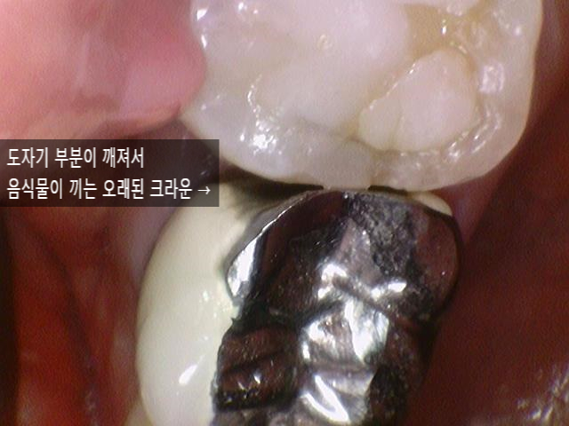 [시청역치과] 미국에서도 크라운 하러 일부러 찾아오는 치과 인증사진 관련 이미지 5