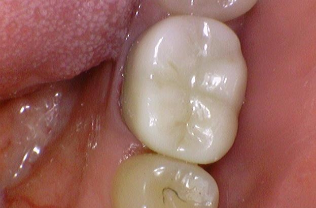 해외에서도 믿고 찾아오는 서울 시청역 치과 연세예감치과에서 소개하는 지르코니아 크라운 관련 이미지 12