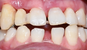 시청역치과 벌어진 앞니를 바르고 이쁘게! 대한심미학회회원치과 관련 이미지 6