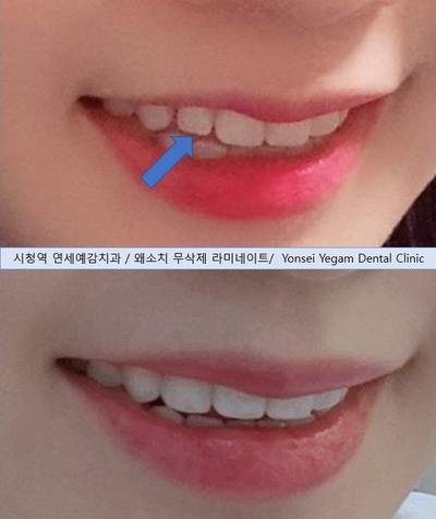 앞니가 작아 고민이신가요? 왜소치 무삭제 라미네이트로 자연스럽게 해결! 해외에서도 찾아오는 치과 비용까지 관련 이미지 7