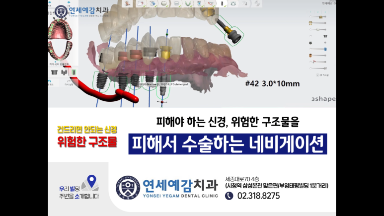 서울역 서울시청역 내비게이션인플란트 유명한 치과 관련 이미지 6