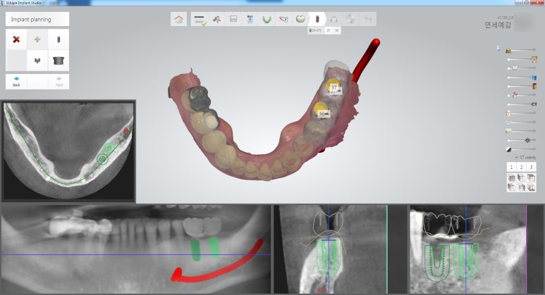 남대문시장 근처 치과 임플란트 연세.예감.치과 관련 이미지 13