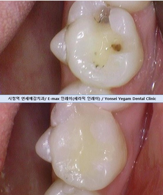 순화동 가까운 충치치료 치과 해외에서도 찾아오는 연세 예감 치과 관련 이미지 3