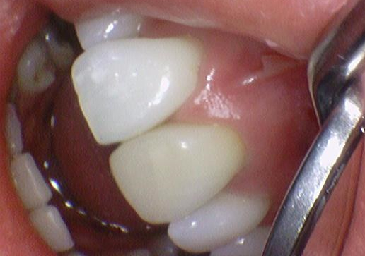 시청역 치과/ 신경이 죽은 치아의 변색 치료 위한 크라운 케이스&가격도 / 외국인 환자분이 눈물을 흘리셨어요 관련 이미지 3