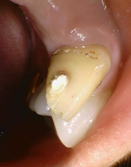 [치과브릿지]남대문치과/깨지고 오래된 앞니브릿지 교체케이스 관련 이미지 4