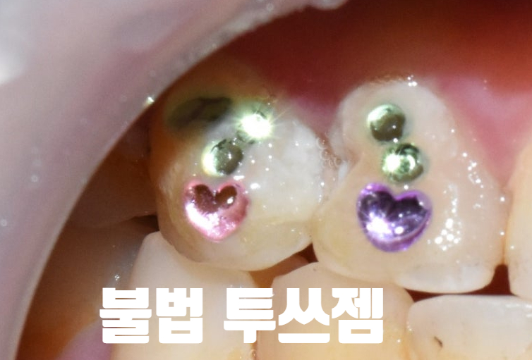 투쓰젬(Tooth gem),굳이 한다면 꼭 치과에서! 이유&비용,실제 치과에서 한 사진까지! 관련 이미지 7