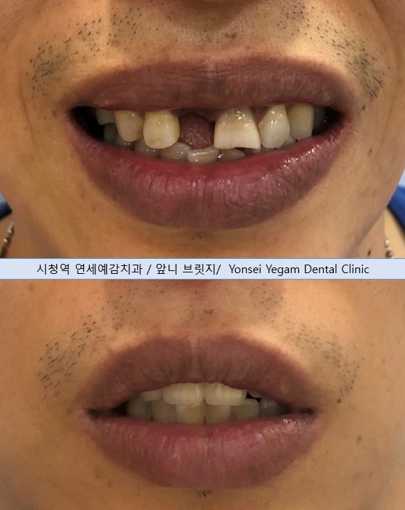 서울시청역 남대문 임플란트 대신에 앞니 브릿지를 한 케이스 관련 이미지 16