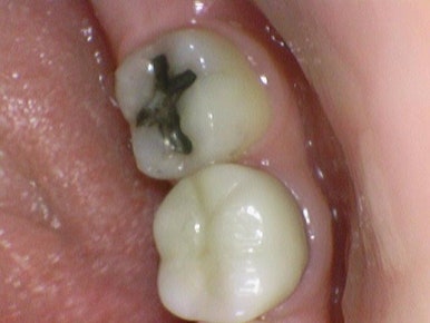 [서울/시청역]어금니 치아가 깨져서 크라운이 필요하다면? 관련 이미지 4