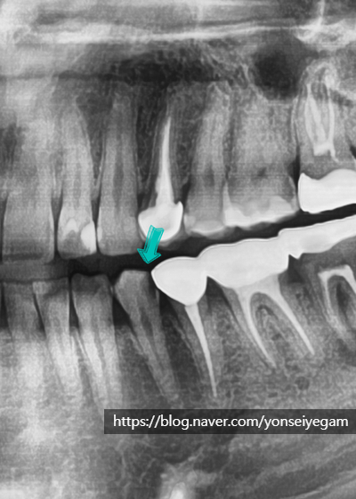 Q&A)충치, 꼭 치료해야 하나요?? 관련 이미지 2