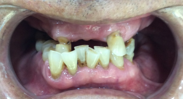 사용중인 틀니가 불편하다면? 임플란트와 틀니가 결합된 임플란트 틀니 추천 관련 이미지 15