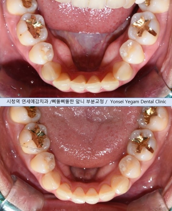 [시청역] 마스크를 벗을 그때를 대비한 이벤트! 치아미백/보톡스/라미네이트/앞니부분교정 이벤트가 안내 관련 이미지 7