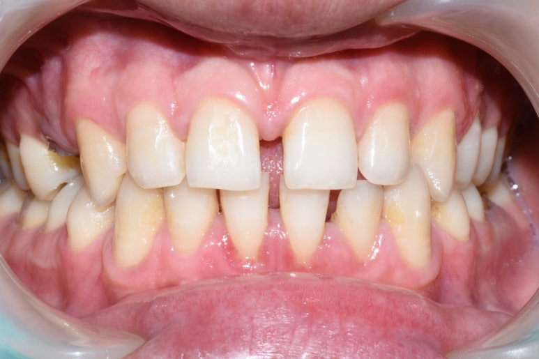 광화문역 스케일링 만19세이상 국민이면 누구나 혜택 관련 이미지 5