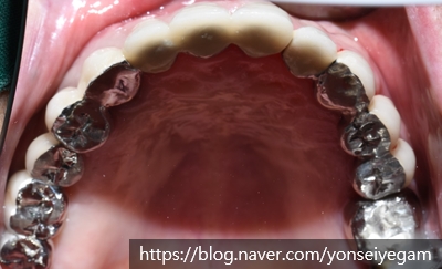 시청역 임플란트&상악동수술?상악동거상술? 어떻게 진행되었을까요 관련 이미지 6