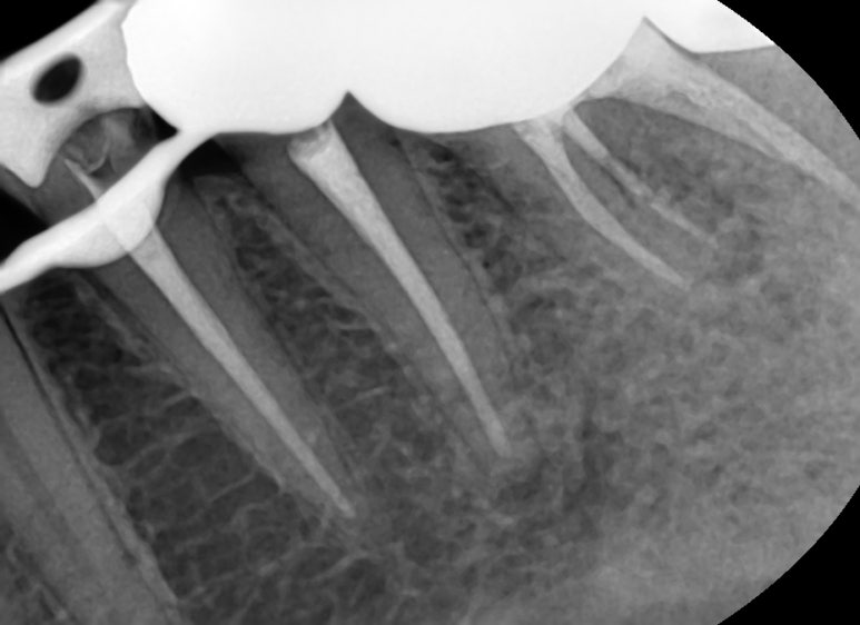 Q&A)충치, 꼭 치료해야 하나요?? 관련 이미지 5