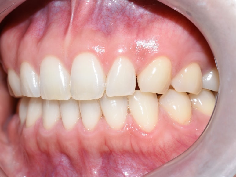 앞니 사이 벌어진 부위 레진치료의 방법 관련 이미지 4