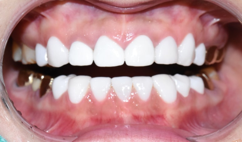 [시청역/광화문] 부식된 노란치아. 정말 하얀, 새하얀 치아로 만들고 싶어요 비용도 알려드려요 관련 이미지 10