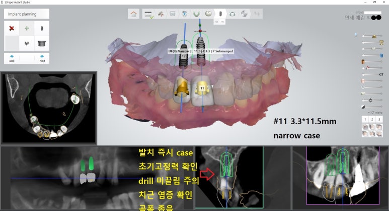 [북창동 치과/연세예감치과]내비게이션임플란트소개 관련 이미지 15