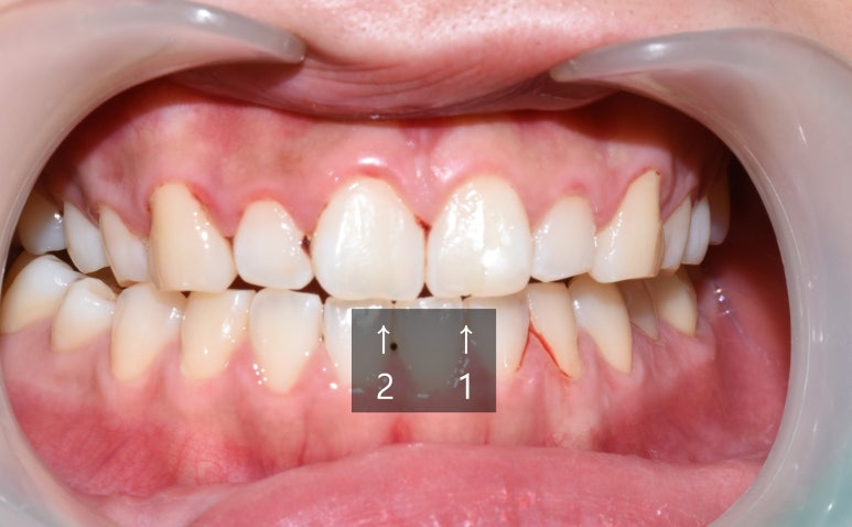 [서울역/치과] 앞니가 조금 아주조금 깨졌어요 치료가능한가요? 관련 이미지 1
