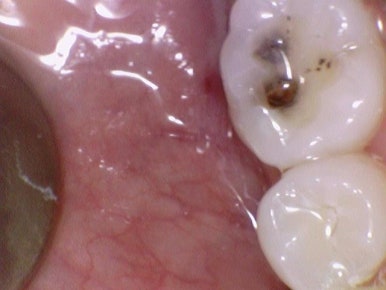 충정로 치과 인레이 해야한다고 들었는데 충치가 안보여요 관련 이미지 11