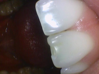 해외에서도 찾아오는 앞니레진치료, 광화문 시청역 서울역 근처 연세예감치과 외국인도 찾는 이유 관련 이미지 5