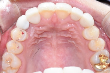 [광화문/시청역 치과]임플란트+크라운 +무삭제 라미네이트 복합 혼합 "6개 앞니 케이스" 소개/라미네이트가격 관련 이미지 4