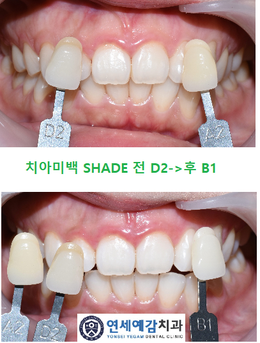 시청역,광화문,서울역 치과 치아 미백에 대해 알려드려요, 치아미백이벤트소개,치아미백가격 관련 이미지 2