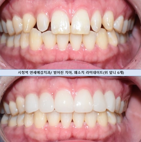 서울 시청역/서울역/ 벌어진 앞니, 왜소치 라미네이트 유명한 치과/ 전후 비교와 가격 관련 이미지 3