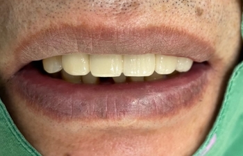 [치과브릿지케이스] 앞니가 너무 많이 흔들려서 발치해야 할 것 같아요 관련 이미지 7