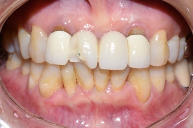 서울시청역 남대문 임플란트 대신에 앞니 브릿지를 한 케이스 관련 이미지 14