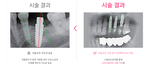 [시청역/을지로] 임플란트 진단 상담 비용? 관련 이미지 3