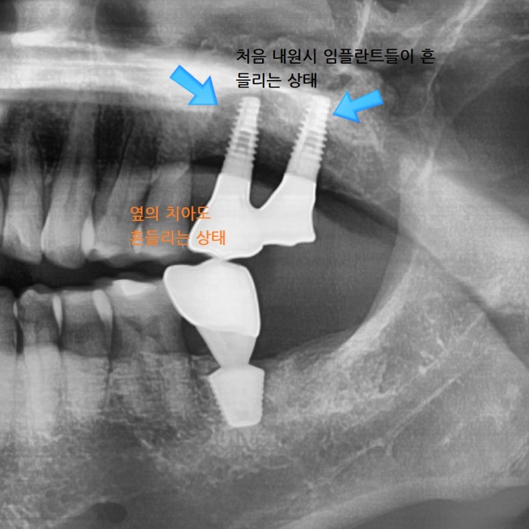 [서울시청역/케이스]"다른 치과에서 한 임플란트가 흔들려서 빼야할 것 같아요" 관련 이미지 5