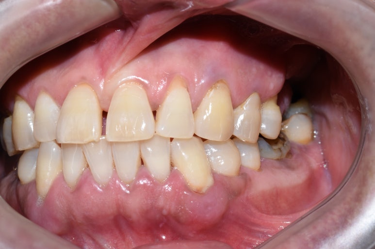 [서울시청역/남대문]어금니임플란트+상악동거상술(뼈이식):실제케이스 관련 이미지 8