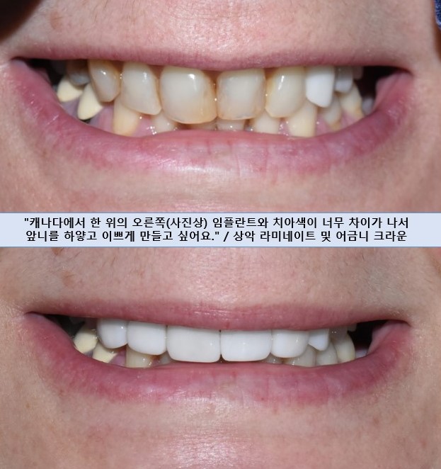 앞니가 작아 고민이신가요? 왜소치 무삭제 라미네이트로 자연스럽게 해결! 해외에서도 찾아오는 치과 비용까지 관련 이미지 10