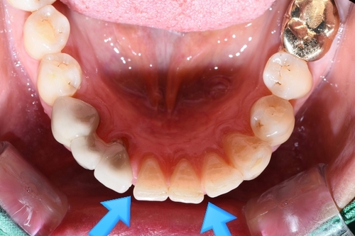 벌어진 앞니 교정치료 & 오래된 앞니 브릿지 다시하기 관련 이미지 4