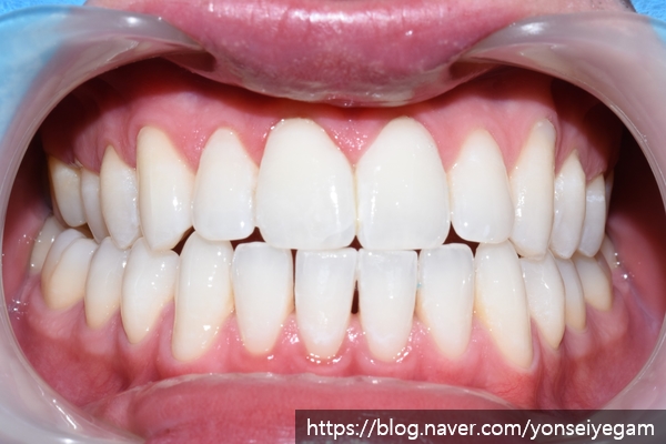 [서울시청역치과/잇몸치료]Q.잇몸에서 피가 나요 관련 이미지 6