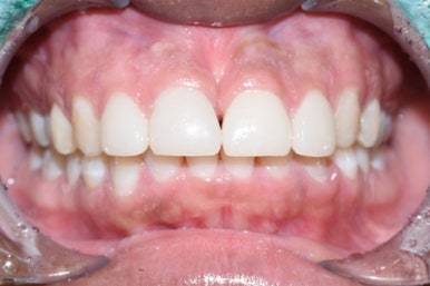 서울시청역치과/ 벌어진 앞니 치아 치료/ 왜소치, 다이아스테마 등/레진, 라미네이트, 부분교정 비교 관련 이미지 25