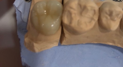 연세예감치과에서 알려드리는 심미적이고 기능적으로도 우수한 e-max인레이 치료 관련 이미지 4