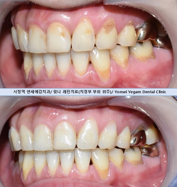 충정로치과,을지로치과/ 치아뿌리쪽이 패이고 부식된 것처럼 누렇게 보인 치경부 마모 레진 치료 증례 관련 이미지 8
