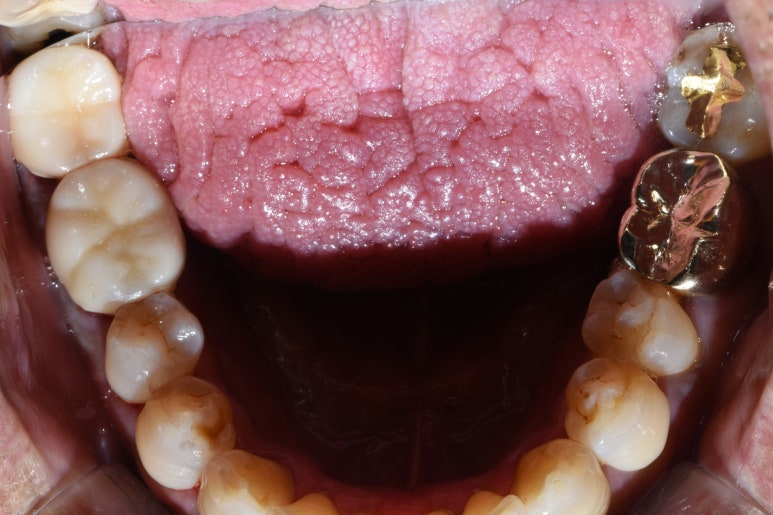 시청역치과/ "금니크라운이 보기싫은데 바꿀 수 있나요?" 관련 이미지 3