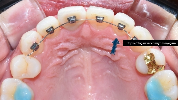 Q&A:"교정을 예전에 오래전에 했는데 앞니치아가 삐뚤어졌어요"해결방법은, 비용은? 관련 이미지 7