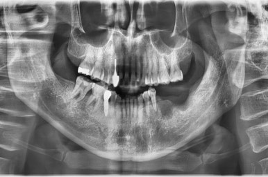 충정로 서울역 근처 고난도 & 재수술 임플란트 수술 치과 관련 이미지 8