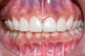 [시청역/광화문]라미네이트케이스:"치아가 작아서 옹졸해 보여요. 치아가 길어보이면 좋겠어요" 관련 이미지 8