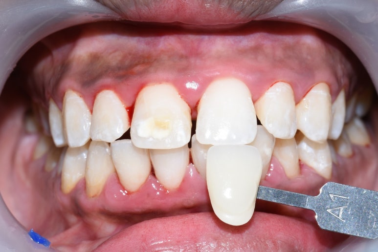 [서울역/충정로/치과] 화이트스팟+충치가 결합된 치아의 resin레진치료 케이스 관련 이미지 3