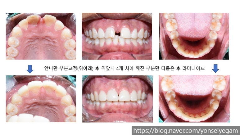 [시청역 광화문 근처치과]  이벤트 가격안내 관련 이미지 10