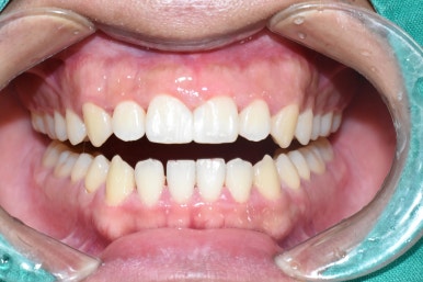 서울시청역치과/ 벌어진 앞니 치아 치료/ 왜소치, 다이아스테마 등/레진, 라미네이트, 부분교정 비교 관련 이미지 14