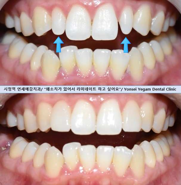 [서울/시청역] 왜소치 라미네이트 케이스 사례/비용/알려드려요 관련 이미지 1